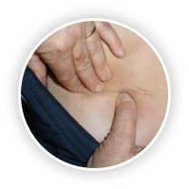 Scars & Burns terapy